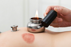 拔火罐减肥 这样做瘦身很有效